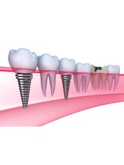 Dental Implants - Family Dent