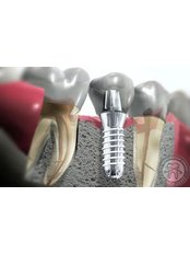 Dental Implants - Lumi-Dent