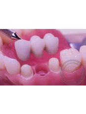 Dental Bridges - Lumi-Dent