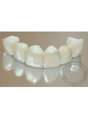 Dental Bridges - Lumi-Dent