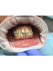 All-on-6 Dental Implants - Medical Democracy agency