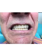All-on-4 Dental Implants  - Medical Democracy agency