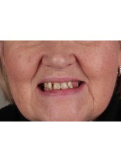 Dentures - Victoria Dent