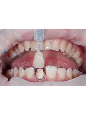 Dental Crowns - Victoria Dent