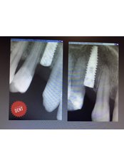 Dental Implants - Victoria Dent