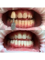 Teeth Whitening - Victoria Dent