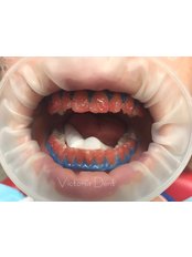 Chemical Teeth Whitening - Victoria Dent