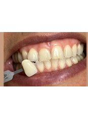 Teeth Whitening - Dental Office