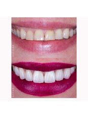 Ceramic Veeners - Diamond Dental
