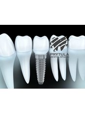 Dental Implants - Prytula Dental Studio