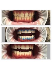Teeth Whitening - Avrodent Odessa