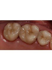 Dental Crowns - Wesley Chapel Dentistry