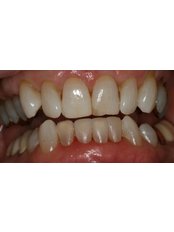 Dental Bonding - Wesley Chapel Dentistry