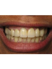 Dental Crowns - John F. Carpenter, D.M.D., M.A.G.D.