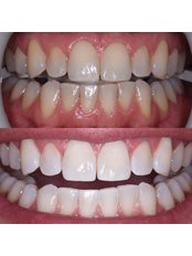 Teeth Whitening - Inna Chern DDS