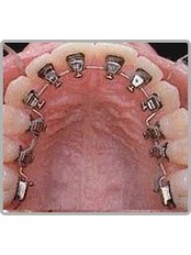 Braces - Ellis Orthodontics