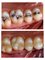 Monarch Dentistry - FILLINGS 