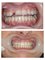 Monarch Dentistry - IMPLANT RESTORATION 