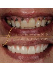 All-on-4 Dental Implants - Lance Timmerman, DMD