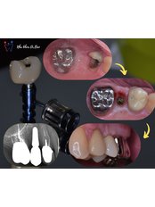 Dental Consultation - Dr.Bao Dental Clinic - Dental Implant Center