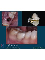 Dental Consultation - Dr.Bao Dental Clinic - Dental Implant Center