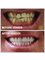 TGM Dental - Da Nang Branch - TGM Dental DN - Before and After Veneer 