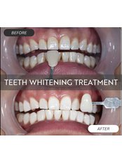Teeth Whitening - Greenfield Dental