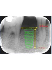 Digital Dental X-Ray - Viet Uc Dental Clinic
