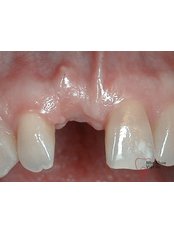 Single Implant - Viet Uc Dental Clinic