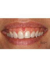 Gum Contouring and Reshaping - Viet Uc Dental Clinic