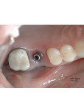 Metal-Free Implants - Viet Uc Dental Clinic