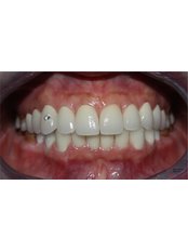 Zirconia Crown - Viet Uc Dental Clinic