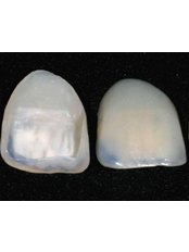 Porcelain Veneers - Viet Uc Dental Clinic