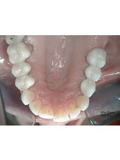 Restoration of Implants - Viet Uc Dental Clinic