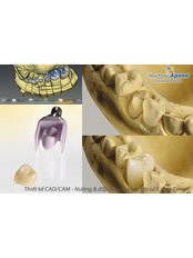 Porcelain Crown - Apona Dental Clinic