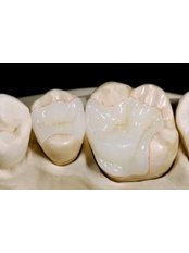 Porcelain Inlay / Onlay - Apona Dental Clinic