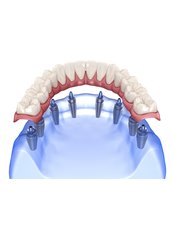 All-on-8 Implant Package (Nobel) - Camtu Dental Clinic