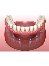 All-on-6 Implant Package (Korea) - Camtu Dental Clinic