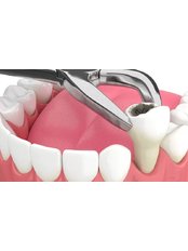 Extraction - Camtu Dental Clinic