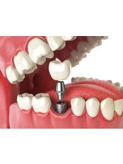 Single Implant (Nobel) - Camtu Dental Clinic