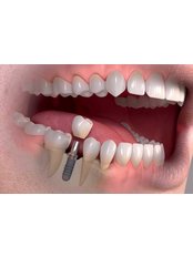 Single Implant (Korea) - Camtu Dental Clinic