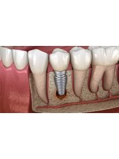 Single Implant (USA) - Camtu Dental Clinic
