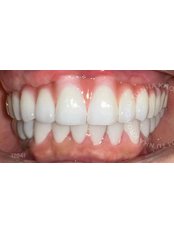 All-on-4 Implant Package (Straumann) - Camtu Dental Clinic