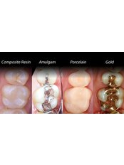 Fillings - Camtu Dental Clinic