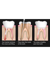 Root Canal - Camtu Dental Clinic