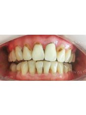 Veneers Mutilayer II - Camtu Dental Clinic