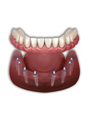All-on-8 Implant Package (Korea) - Camtu Dental Clinic