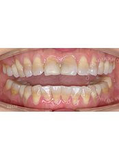 Dental Crowns - Bio DT 1 - Camtu Dental Clinic