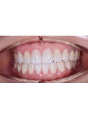 Dental Crowns - Fuzir 2 - Camtu Dental Clinic