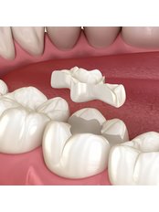 Ceramic Inlay or Onlay - Camtu Dental Clinic